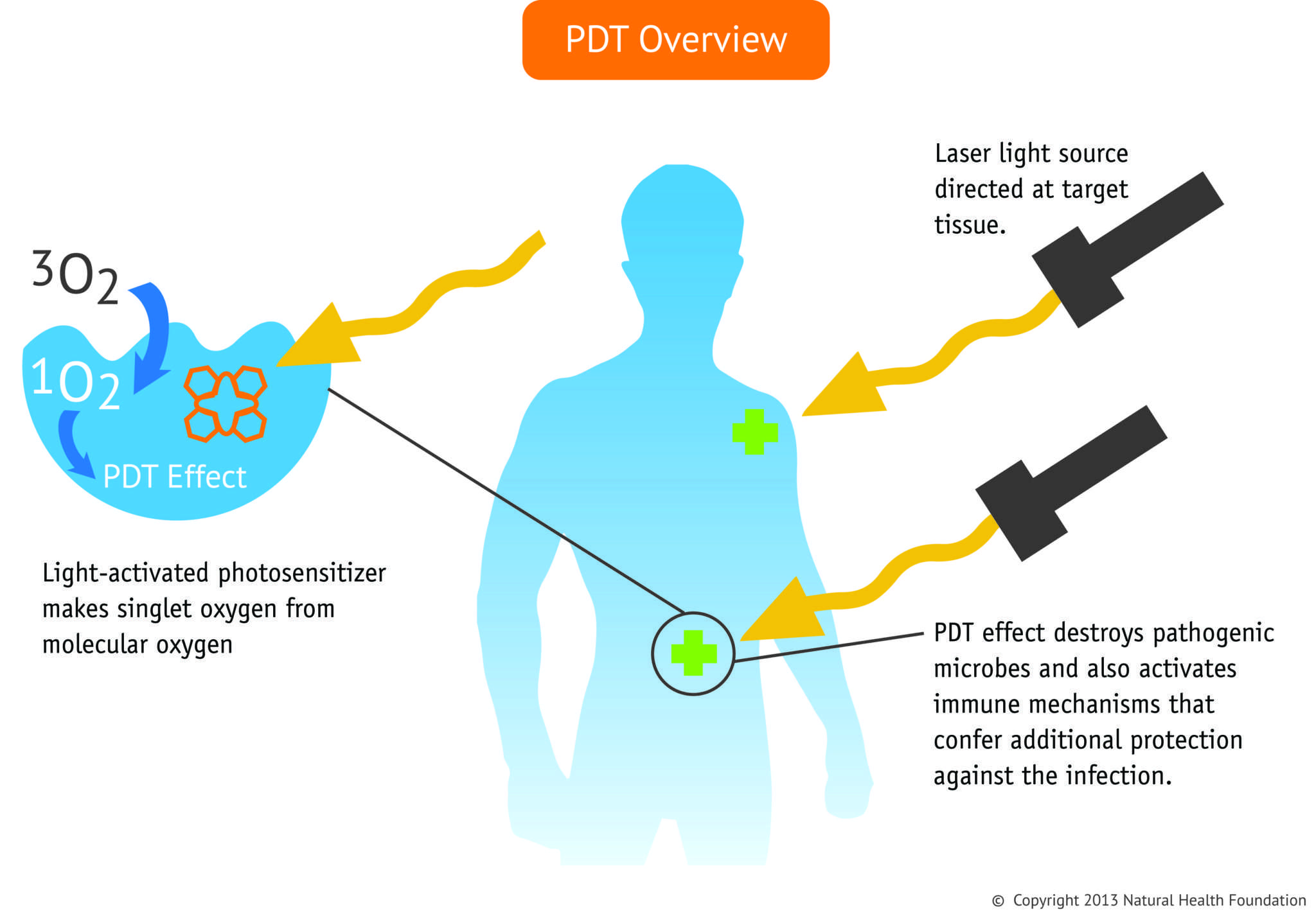 Pdt. Antibacterial Photodynamic Therapy. Photodynamic Therapy of Cancer mechanism. Photodynamic Therapy Light Oxygen.