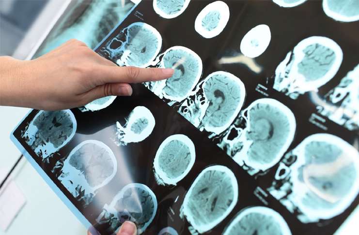 Parkinson ve Alzheimer hastaları için bir umut olabilir