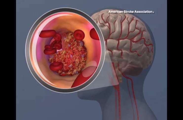 ağır bir felç tipi olan ‘intracerebral hemorrhage (ICH)’