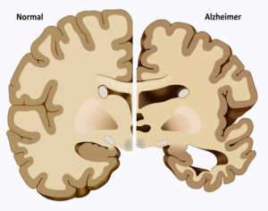 Alzheimer, Parkinson ve Huntington hastalıklarının nedeni anormal bir protein mi sorusu akılları karıştırıyor?