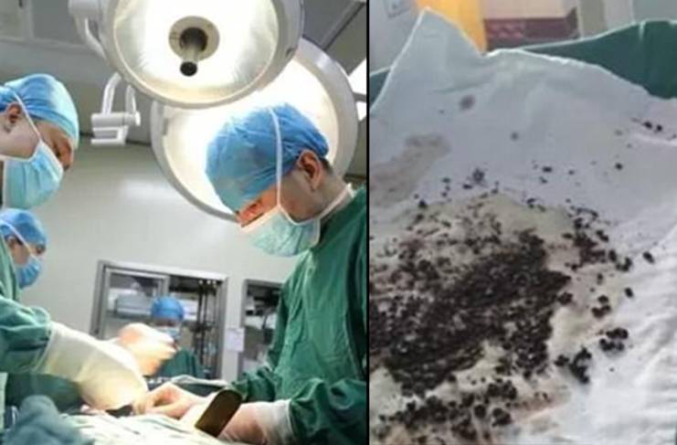 Tek operasyonda tüm taşlar alındı